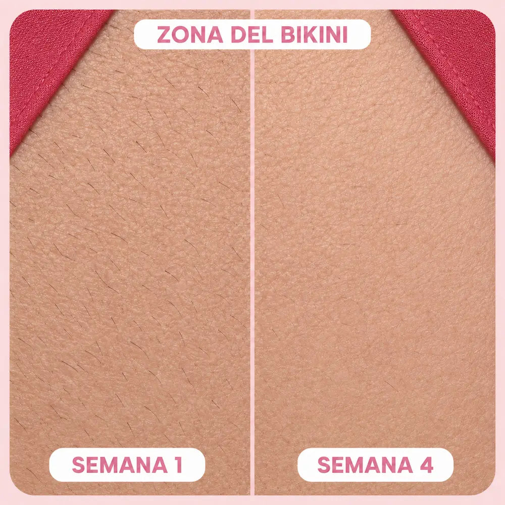 SKINLUME™ – Depiladora laser permanente