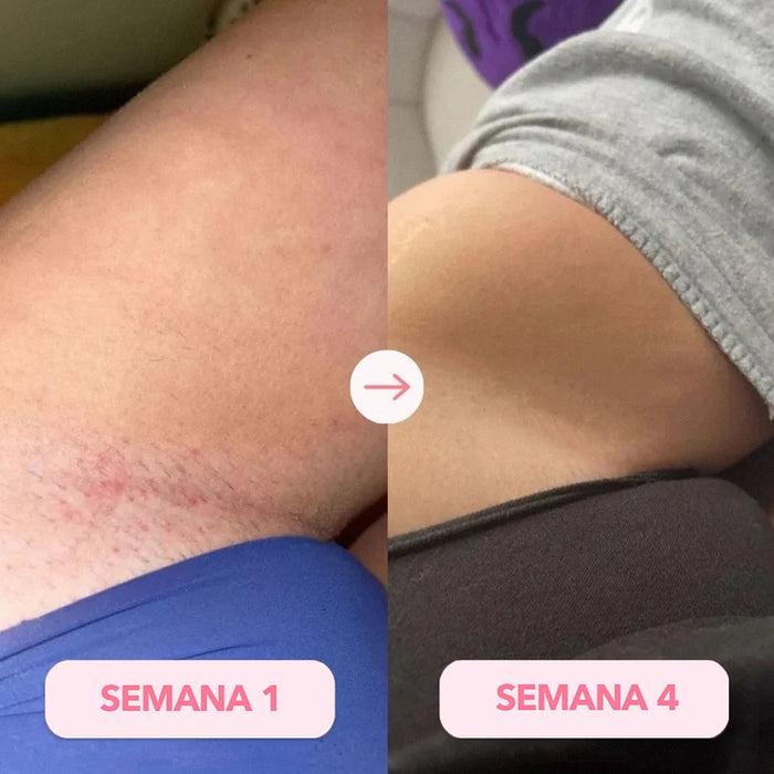 ↓ ALIVIO DESDE LA PRIMERA APLICACIÓN↓