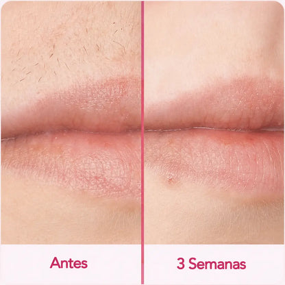 SKINLUME™ – Depiladora laser permanente